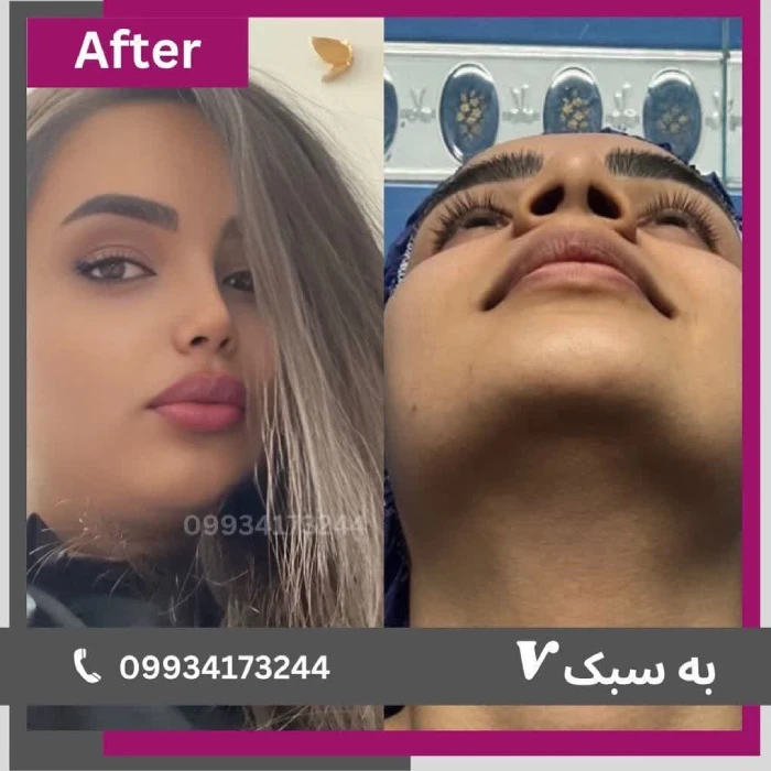 نمونه کار عمل بینی دکتر آرزو خوانسارینیا ۵ | بهترین جراح بینی در تهران