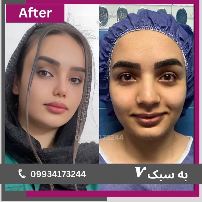 نمونه کار عمل بینی دکتر آرزو خوانسارینیا ۶ | بهترین جراح بینی در تهران
