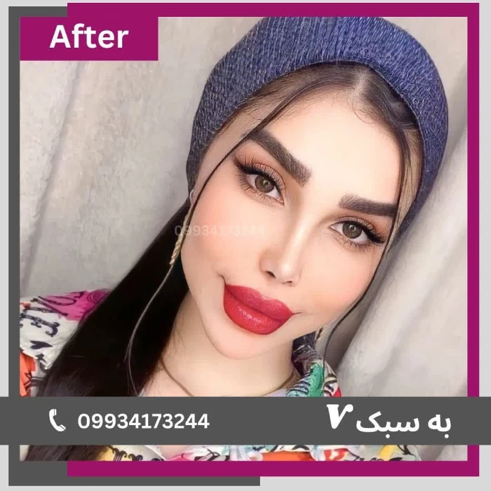نمونه کار عمل بینی دکتر آرزو خوانسارینیا ۴ | بهترین جراح بینی در تهران