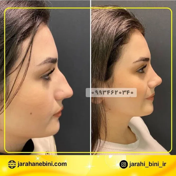 نمونه نتیجه عمل بینی طبیعی دکتر اکبر اعتمادی 6 | بهترین جراح بینی در تهران