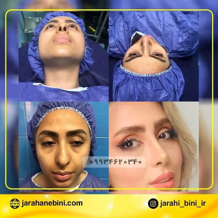 نمونه قبل و بعد عمل بینی دکتر اکبر اعتمادی 5 | بهترین جراح بینی در تهران