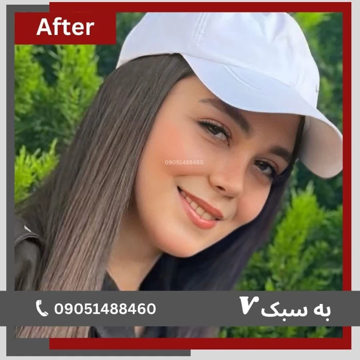 نمونه کار جراحی بینی دکتر خسرو مقتدر ۲ | بهترین جراح بینی در تهران