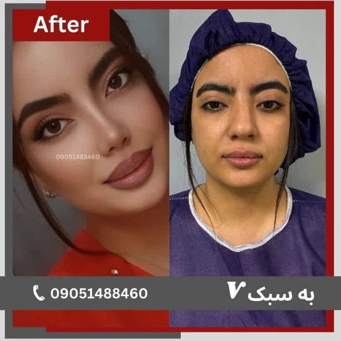 نمونه کار جراحی بینی دکتر خسرو مقتدر ۴ | بهترین جراح بینی در تهران