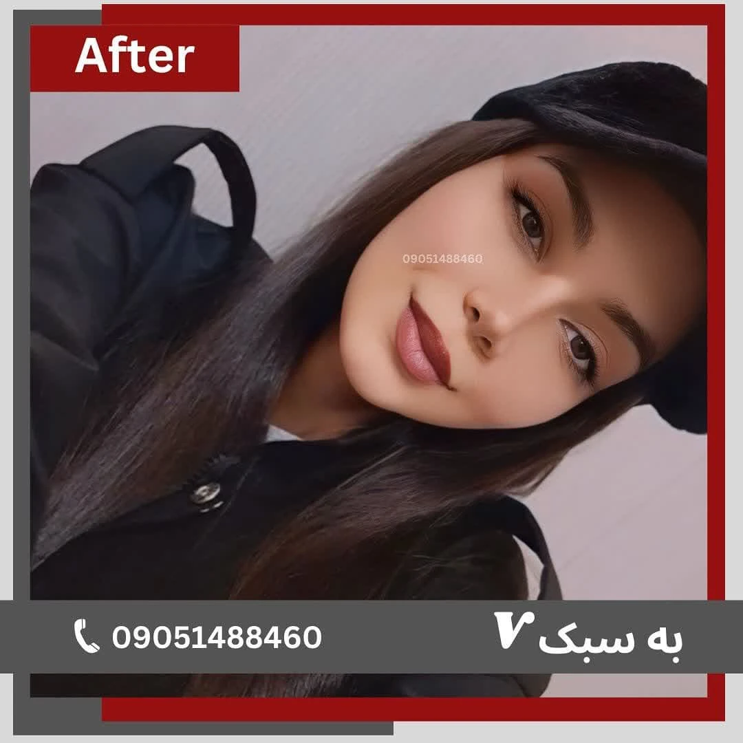 نمونه کار جراحی بینی دکتر خسرو مقتدر ۱ | بهترین جراح بینی در تهران