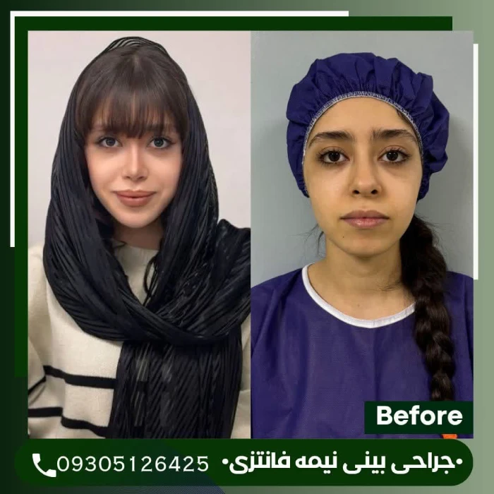 نمونه کار جراحی بینی طبیعی دکتر علی شکرریز 2 | بهترین جراح بینی در تهران