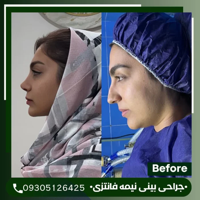 نمونه جراحی بینی نیمهفانتزی دکتر علی شکرریز 3 | بهترین جراح بینی در تهران