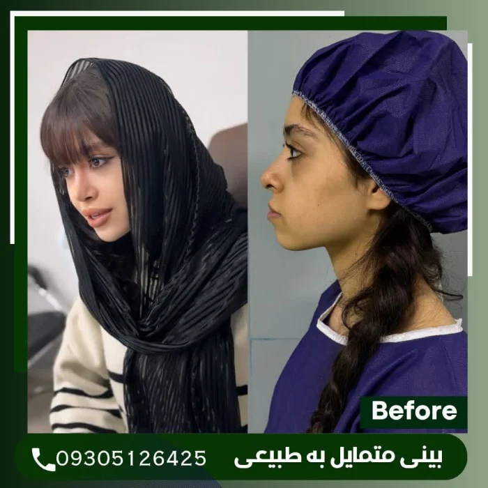 نمونه قبل و بعد عمل بینی دکتر علی شکرریز 4 | بهترین جراح بینی در تهران