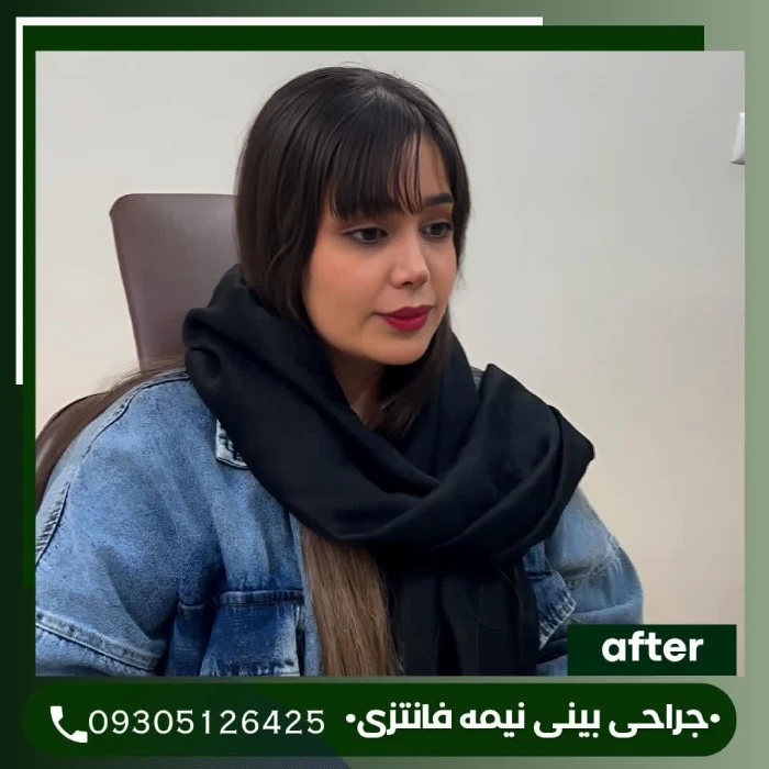 نمونه کار جراحی بینی دکتر علی شکرریز 1 | بهترین جراح بینی در تهران
