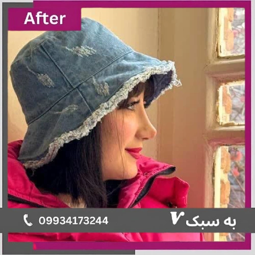 نمونه کار جراحی بینی دکتر آرزو خوانسارینیا ۱ | بهترین جراح بینی در تهران