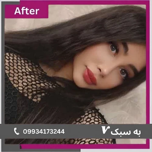 نمونه کار جراحی بینی دکتر آرزو خوانسارینیا ۲ | بهترین جراح بینی در تهران