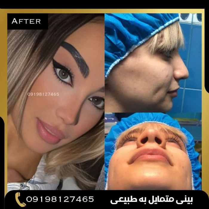 قبل و بعد جراحی بینی دکتر امین بختیاری 4 | بهترین جراح بینی در تهران