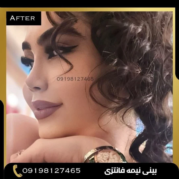 اصلاح قوز و افتادگی بینی دکتر امین بختیاری 5 | بهترین جراح بینی در تهران