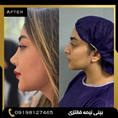 نمونه کار جراحی بینی دکتر امین بختیاری 1 | بهترین جراح بینی در تهران
