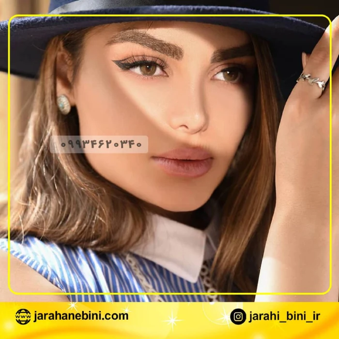 نمونه کار جراحی بینی گوشتی دکتر اکبر اعتمادی 2 | بهترین جراح بینی در تهران