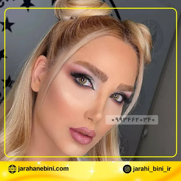 نمونه کار جراحی بینی استخوانی دکتر اکبر اعتمادی 3 | بهترین جراح بینی در تهران