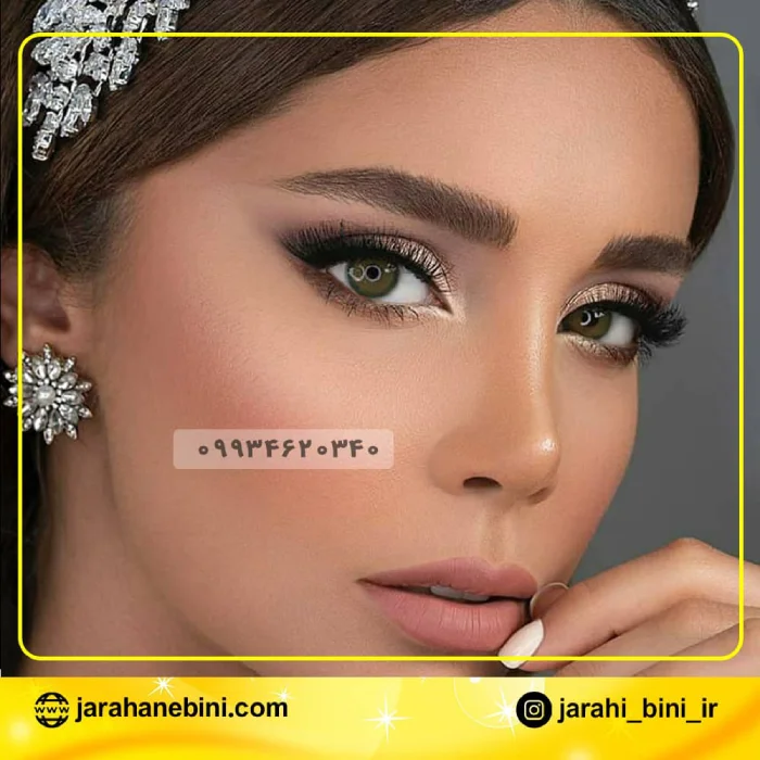 نمونه کار جراحی بینی ترمیمی دکتر اکبر اعتمادی 4 | بهترین جراح بینی در تهران