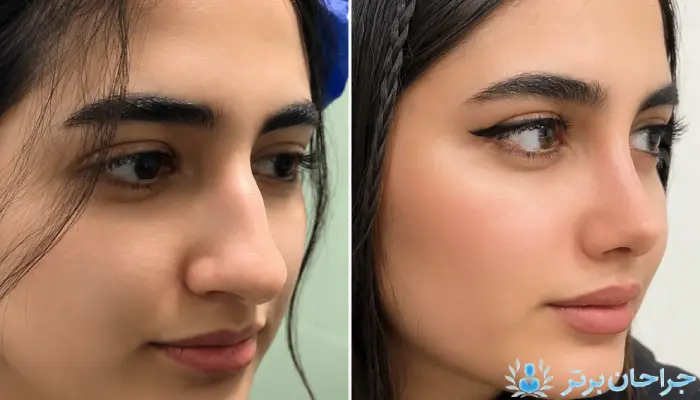 جراحی بینی غضروفی چگونه انجام می‌شود؟