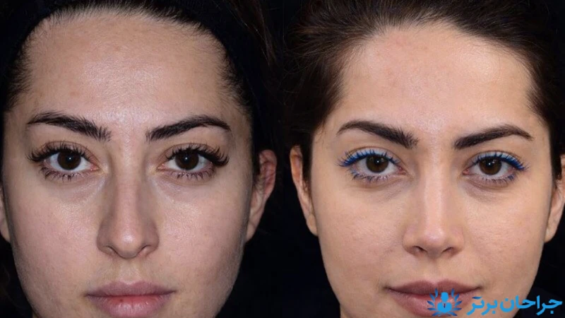 جراحی ترمیمی بینی چیست و برای چه افرادی لازم است؟