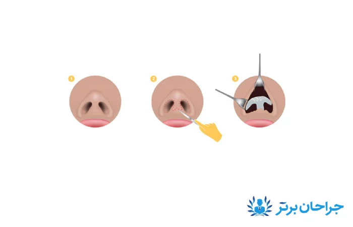 روش های جراحی بینی- بهترین جراح بینی در غرب تهران