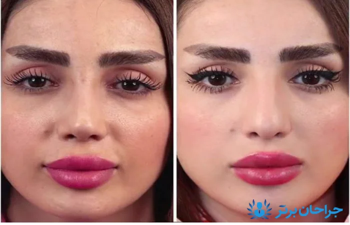 کیس مناسب جراحی بینی از نظر بهترین جراح بینی در غرب تهران