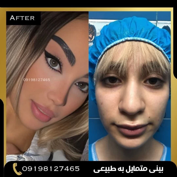 بهترین جراح بینی استخوانی در تهران؛ نمونه جراحی بینی استخوانی دکتر امین بختیاری کیس ۱۲