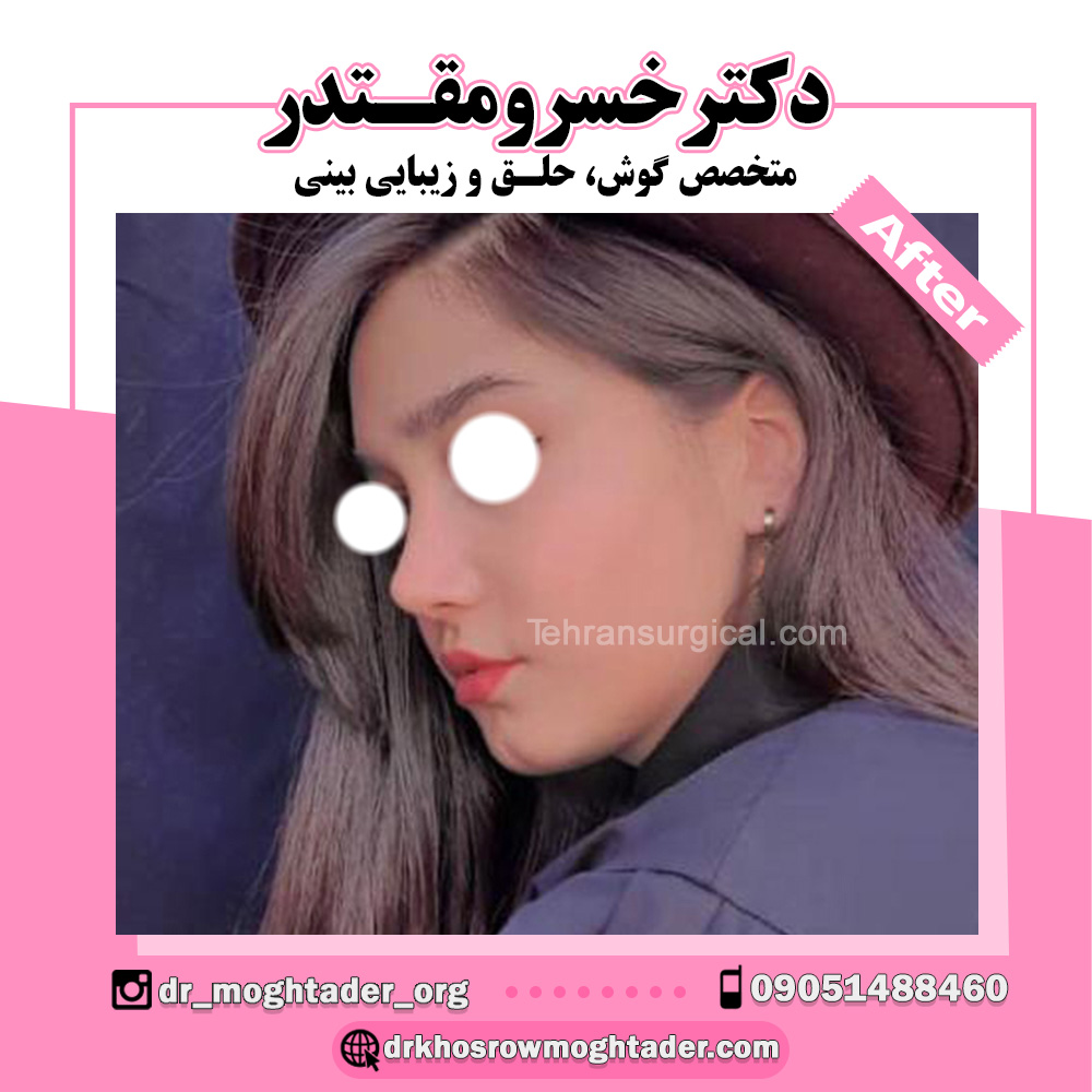 بهترین جراح بینی استخوانی در تهران؛ نمونه کار دکتر خسرو مقتدر شماره ۶