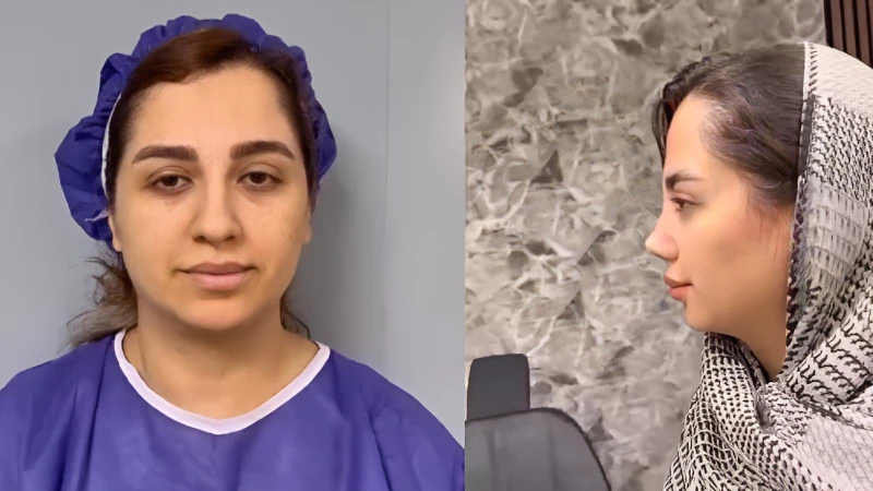 نمونهکار جدید دکتر علی شکرریز؛ کاهش افتادگی نوک بینی و تقویت ساختاری