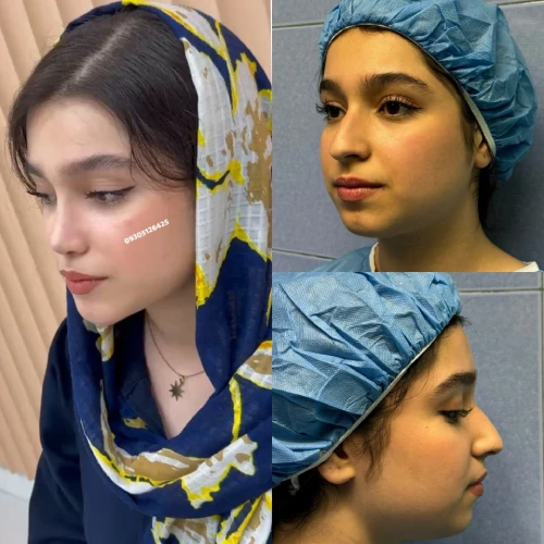 اصلاح قوز و تیپ بینی با هارمونی چهره توسط دکتر علی شکرریز - جدید