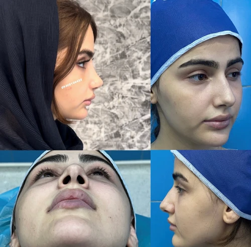 نمونه کار جراحی بینی طبیعی دکتر علی شکرریز شماره دو