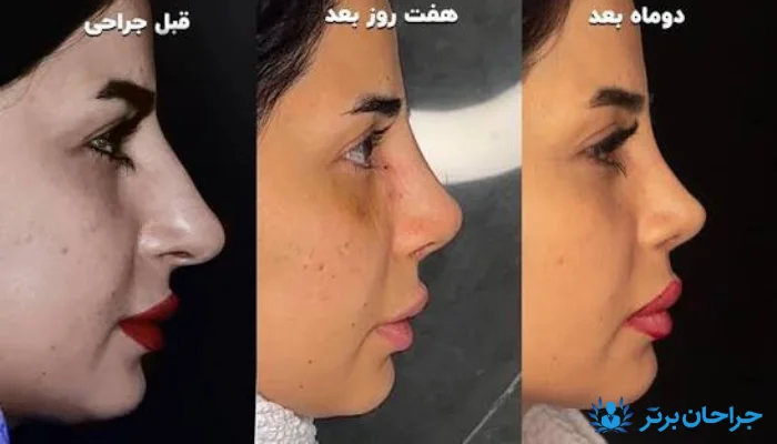 روند کاهش ورم بینی با پوست ضخیم پس از عمل