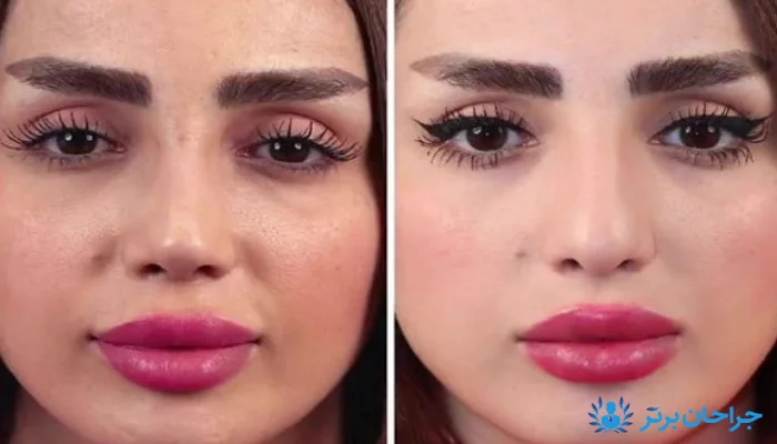 نتیجه عمل بینی با پوست ضخیم از نمای روبه‌رو و نیم‌رخ