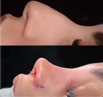 نمونه جراحی بینی منتشرشده از دکتر امیرحسین محمدی مفرد، تصویر اول