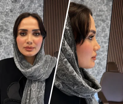 نمونه کارهای جراحی بینی دکتر علی شکرریز
